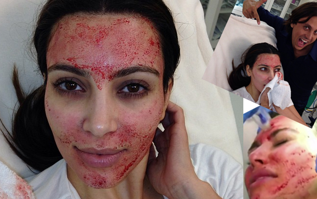 Kim Kardashian gets a vampire facial